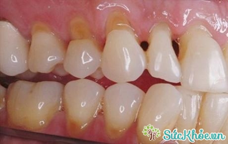Thói quen dùng tăm xỉa răng là nguyên nhân chính khiến kẽ răng bị rộng hơn