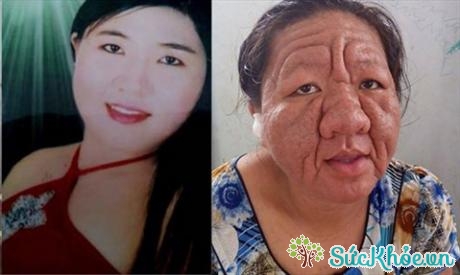 Hình ảnh trước và sau của cô gái 29 tuổi sau khi sử dụng loại kem bôi chứa corticoid