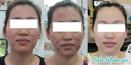 Khuôn mặt bị nhiễm độc corticoid phải trải qua quá trình điều trị lâu dài để hồi phục