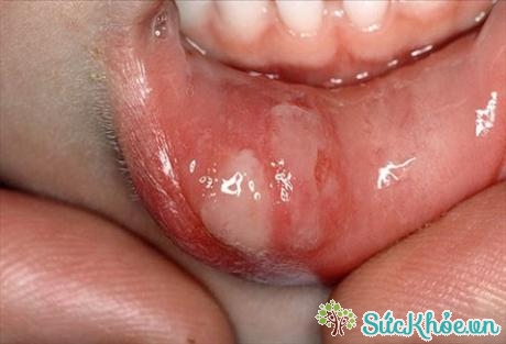 Nếu trên môi có các vết sưng loét lớn, hình tròn hoặc hình bầu dục thì có thể là dấu hiệu của bệnh giang mai ở giai đoạn 1
