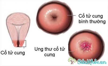 Đối với bệnh nhân ung thư cổ tử cung giai đoạn cuối, dinh dưỡng giúp cho họ khỏe mạnh hơn (Ảnh minh họa: Internet)