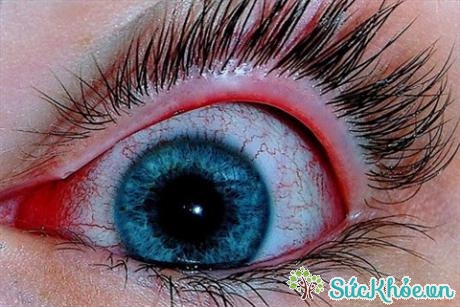 Tuỳ theo các nguyên nhân của bệnh khác nhau mà có các triệu chứng đau mắt đỏ khác nhau