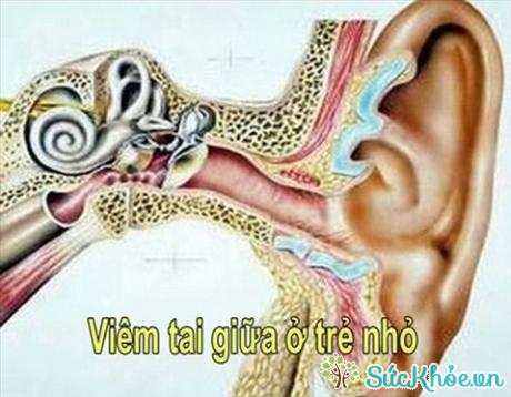 Viêm tai giữa ở trẻ nhỏ có thể gây suy giảm thính lực