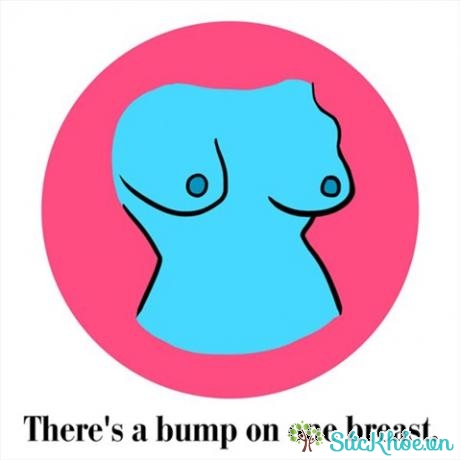 U, bướu xuất hiện ở một bên ngực là dấu hiệu của ung thư vú