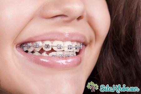 Chỉnh hình răng giúp răng thẳng hàng