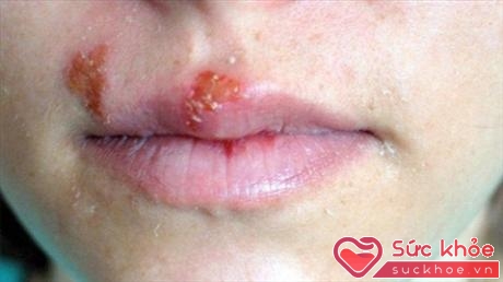 Bệnh rộp môi do vi-rút Herpes simplex gây ra