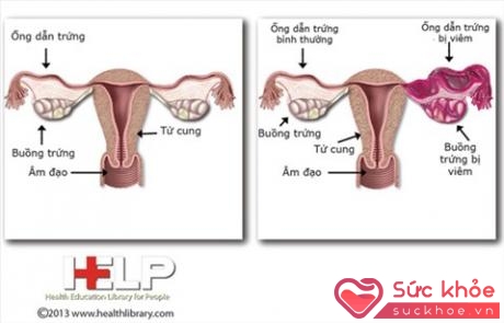 Không một xét nghiệm nào có thể chẩn đoán được tình trạng viêm vùng chậu, do đó các bác sĩ thường dựa vào báo cáo triệu chứng của người bệnh.