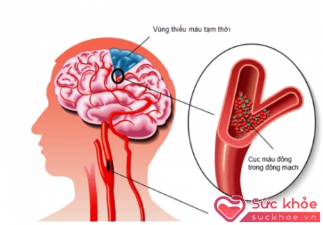 Thiếu máu não cục bộ tạm thời là một nguyên nhân gây rối loạn tiền đình.