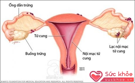 Lạc nội mạc tử cung (endometriosis) được mô tả là một chứng bệnh 