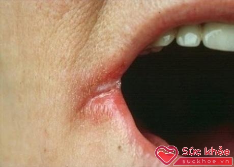 Nước bọt thường xuyên tích tụ bên mép có thể gây viêm góc môi.