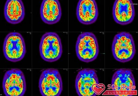Hình ảnh CT scan não người bệnh LBD.