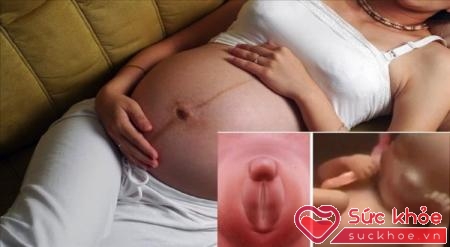 Xem đường sọc nâu trên bụng bầu có thể đoán được giới tính thai nhi đó các mẹ!