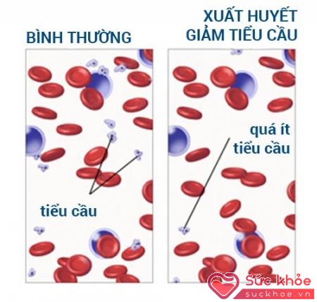 Tiểu cầu là một trong ba tế bào máu cơ bản