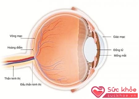 Glaucoma hay còn gọi là cườm nước