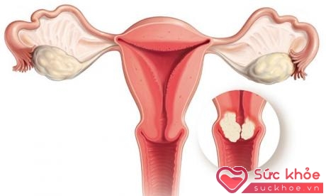 Ung thư cổ tử cung là bệnh lý phụ khoa thường gặp ở nữ giới
