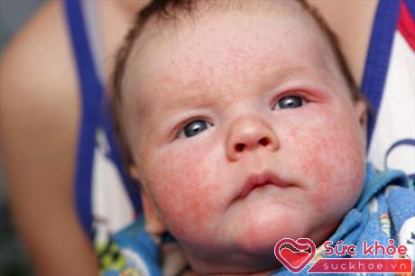 Bệnh chàm sữa (Eczema) là một bệnh viêm da dị ứng thường xuất hiện ở hai bên gò má