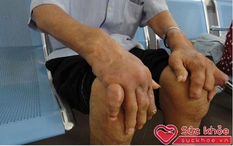 Người mắc bệnh gút lâu năm bị biến dạng các khớp ở bàn tay