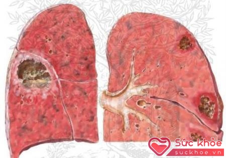 Vôi hóa phổ là sự tích tụ cặn canxi trong phổi
