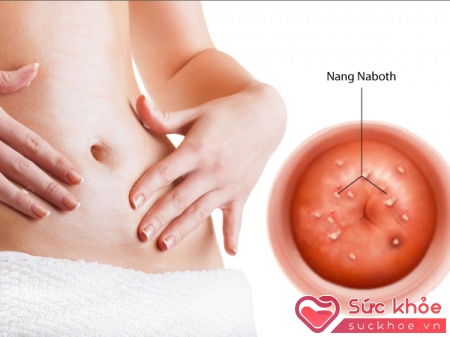 Nang naboth cổ tử cung là những u nhỏ, màu trắng ở cổ tử cung