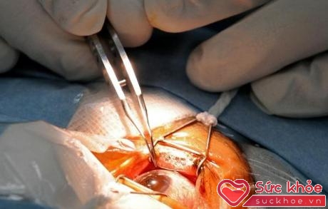 Phẫu thuật đục thủy tinh thể là loại phẫu thuật can thiệp tối thiểu, gần như không chảy máu và đau đớn.