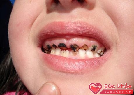 Nguyên nhân gây ra bệnh sâu răng ở trẻ em là vi khuẩn, đường (trong thức ăn) và thời gian.