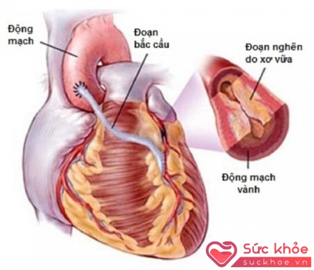Bệnh động mạch vành là tình trạng lòng mạch bị hẹp lại