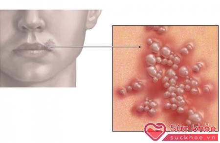 Herpes sinh dục là bệnh nhiễm trùng đường sinh dục