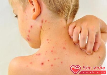 Nhiễm trùng đường huyết hay còn gọi là nhiễm khuẩn huyết