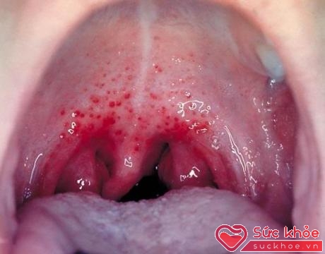 Chấm đỏ tại vòm họng trong bệnh viêm họng cấp do liên cầu khuẩn.