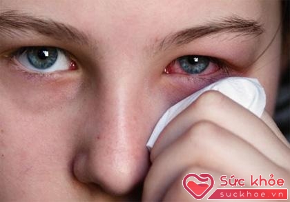 Đau mắt đỏ luôn làm bạn khó chịu và ảnh hưởng tới cuộc sống của bạn rất nhiều.