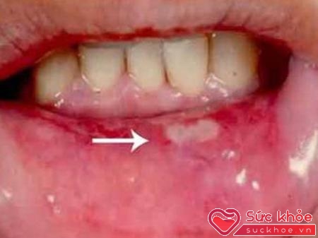 Ung thư khoang miệng nếu được phát hiện sớm thì khả năng khắc phục cao