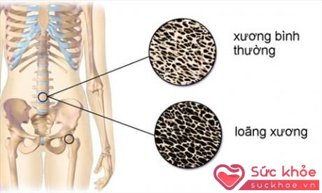 Vitamin K đóng vai trò rất quan trọng trong việc cải thiện mật độ xương của cơ thể