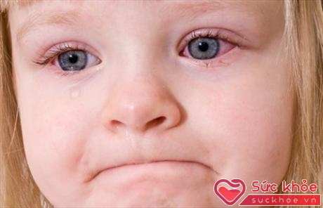 Cần vệ sinh mắt cẩn thận khi trẻ nhiễm bệnh đau mắt đỏ (Ảnh minh họa: Internet)