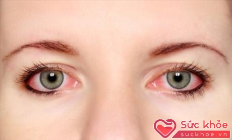 Đau mắt đỏ cần tuân theo chỉ định điều trị của bác sĩ (ảnh minh họa: Internet)