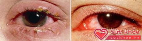Bệnh đau mắt đỏ có kèm rỉ (Bên phải)
