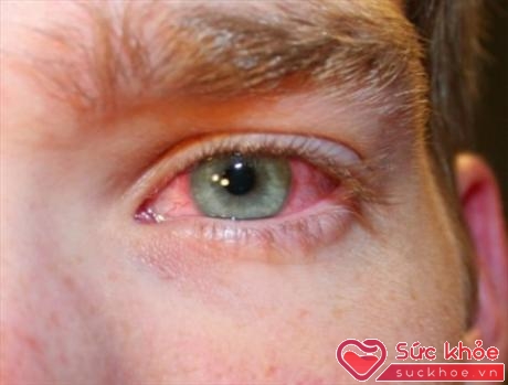 Đa phần bệnh đau mắt đỏ sẽ tự khỏi sau khoảng 7 đến 14 ngày.