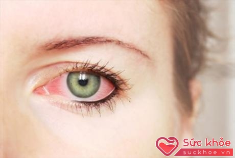 Người bệnh đau mắt đỏ tuyệt đối không nên đắp các loại lá (Ảnh minh họa: Internet)