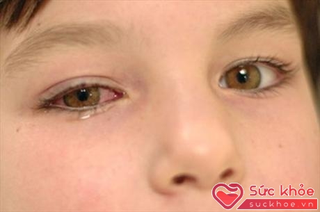 Bệnh đau mắt đỏ rất dễ bùng phát thành dịch (Ảnh minh họa: Internet)