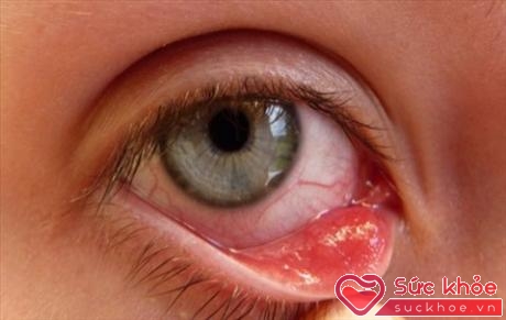 Đau mắt đỏ là bệnh dễ chữa xong vẫn có khả năng gây mù nếu điều trị không đúng.