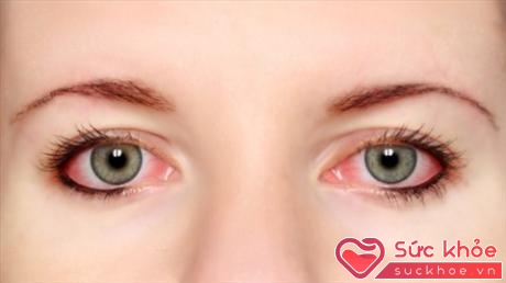 Bệnh đau mắt đỏ cũng dễ lây lan như cảm cúm (Ảnh minh họa: Internet)