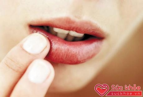 Các vết nứt ở góc miệng có thể do sự suy giảm sắt, kẽm, vitamin nhóm B như niacin (B3), riboflavin (B2), và vitamin B12
