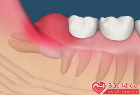 Nhiều bệnh lý liên quan đến nướu răng như viêm nha chu
