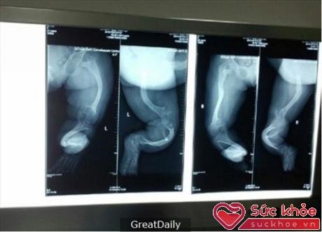 Hình ảnh X-Quang cho thấy chân của cháu bé bị cong (Ảnh: GreatDaily)