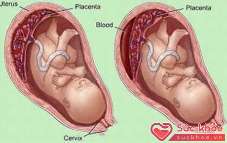 Hình ảnh bong rau non ở bà mẹ mang thai bị sốt xuất huyết.