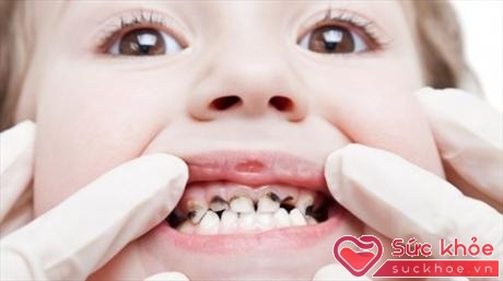 Bổ sung vitamin và khoáng chất để trẻ không bị sâu răng
