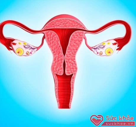 Nếu các mô xung quanh của phụ nữ không phát triển đúng cách thì người phụ nữ không thể giải phóng trứng trong chu kỳ kinh nguyệt hàng tháng
