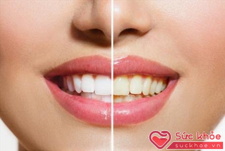 Răng đổi màu là một trong những dấu hiệu nhận biết men răng đã bị bào mòn