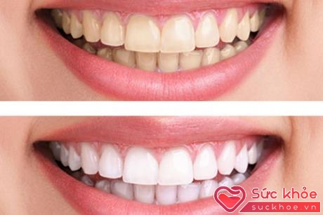 Thuốc muối giúp loại bỏ các vết xỉn màu trên bề mặt răng, đồng thời làm giảm nồng độ a-xít trong miệng