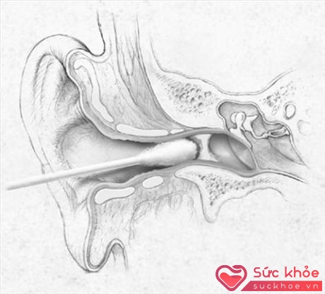Sai lầm khi ngoáy tai sẽ dẫn đến viêm ống tai.