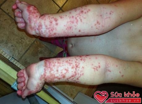 Những vết đỏ như phỏng xuất hiện là triệu chứng điển hình của nhiễm vi khuẩn tụ cầu da (Ảnh: Internet)